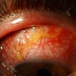 Ciprofloxacin Eye Drops (Ciplox): Effectiveness, Safety, and Proper Use
