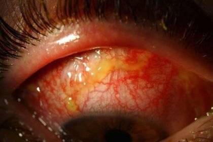 Ciprofloxacin Eye Drops (Ciplox): Effectiveness, Safety, and Proper Use