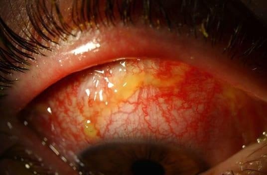 Ciprofloxacin Eye Drops (Ciplox): Effectiveness, Safety, and Proper Use